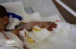 دست قطع شده کودک ۳ ساله هوارندی با موفقیت پیوند خورد + تصاویر