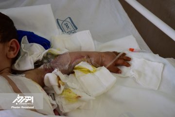 دست قطع شده کودک ۳ ساله هوارندی با موفقیت پیوند خورد + تصاویر